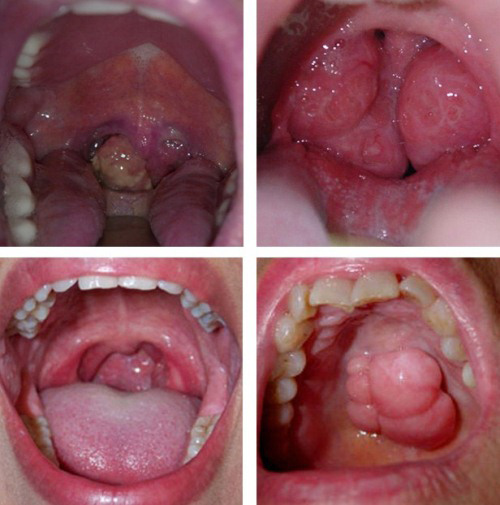 ung thư vòm họng ung thư vòm họng