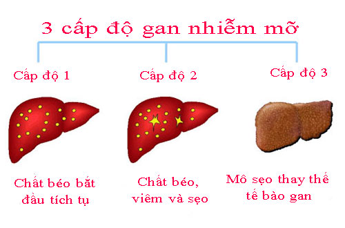 20 - 30% dân số Việt Nam mắc bệnh gan nhiễm mỡ