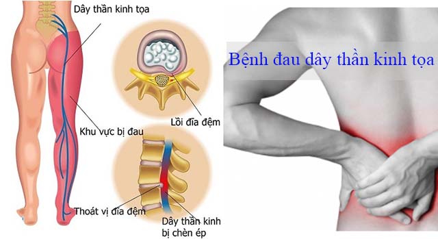 Cách nhận biết đau dây thần kinh tọa