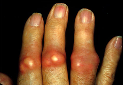 bệnh gút bệnh gút