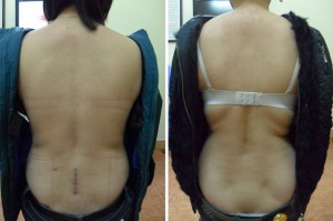 bệnh nhân cấy chỉ bệnh nhân cấy chỉ
