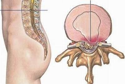 Phương pháp cấy chỉ chữa bệnh thoát vị đĩa đệm cột sống