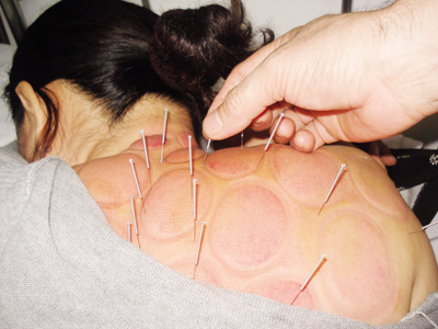 Chữa đau cổ, đau vai gáy bằng xoa bóp bấm huyệt
