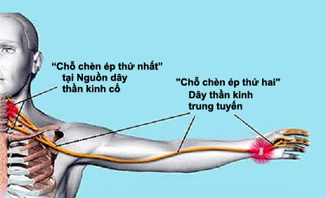 đau cổ tay đau cổ tay