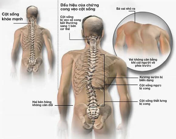 cong vẹo cột sống cong vẹo cột sống