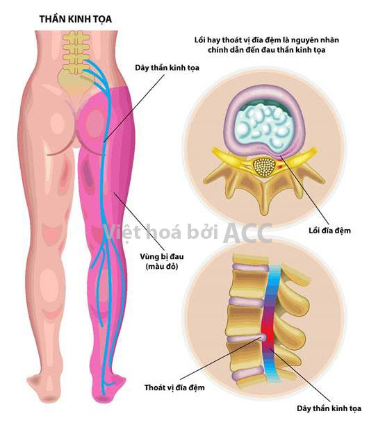 đau thần kinh tọa đau thần kinh tọa