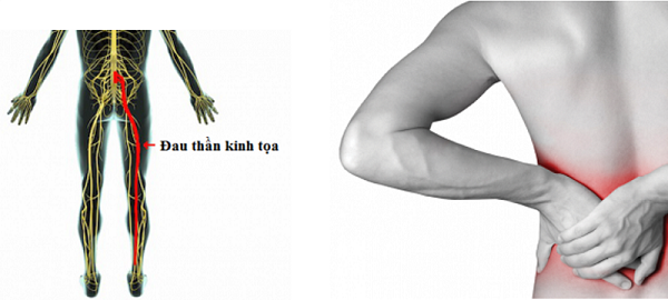 Điều trị bệnh đau dây thần kinh tọa