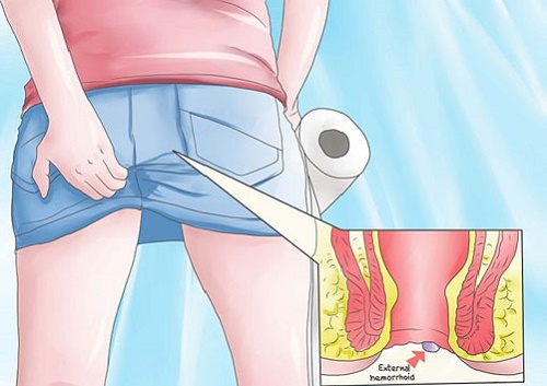 8 nguyên nhân gây đau hậu môn