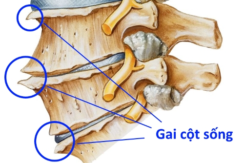 Tìm hiểu về bệnh cột sống tre