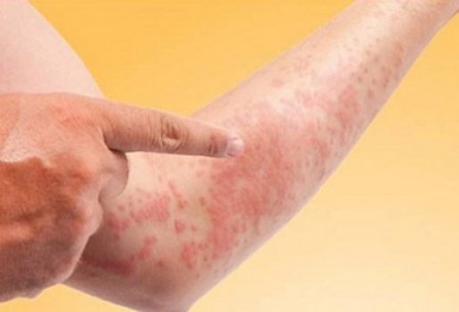 Nóng trong người có phải bị bệnh gan?