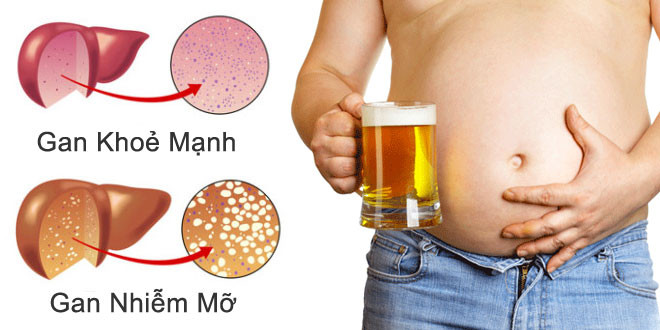 5 dấu hiệu tố bạn bị gan nhiễm mỡ