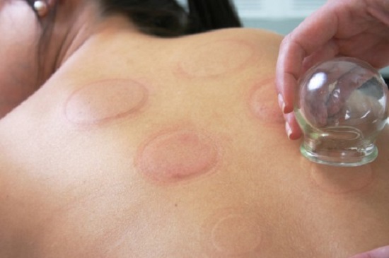 giác hơi chữa bệnh giác hơi chữa bệnh