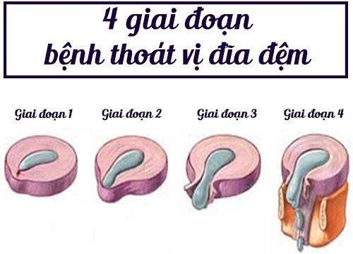 Thoát vị đĩa đệm giai đoạn nào nguy hiểm nhất?