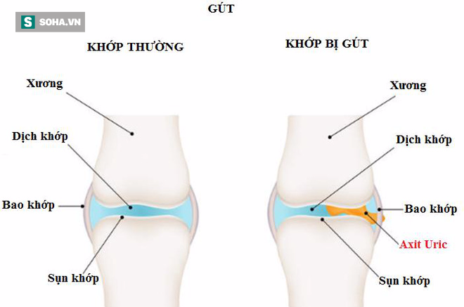 bệnh gút bệnh gút