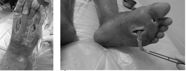 Người tiểu đường không lo cắt cụt chi nhờ các phương pháp này