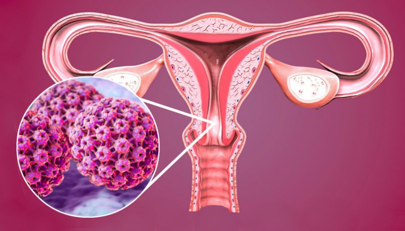 Hiểu đúng về virus HPV gây ung thư