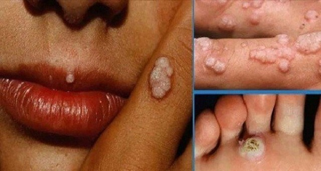 Có phải virus HPV có sẵn trong cơ thể mỗi người?