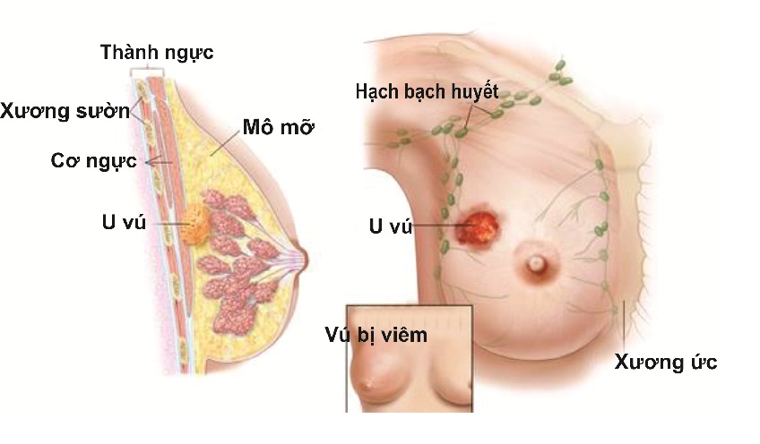 khối u vú khối u vú