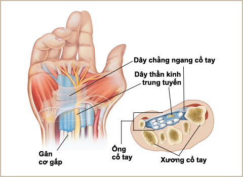 Nguyên nhân gây đau ống cổ tay