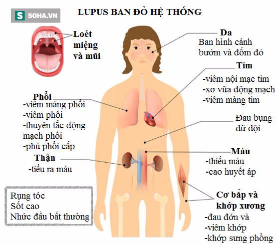 bệnh lupus bệnh lupus