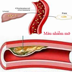 Mỡ trong máu (máu nhiễm mỡ) là bệnh gì?