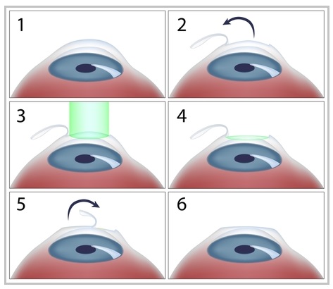mổ cận thị lasik