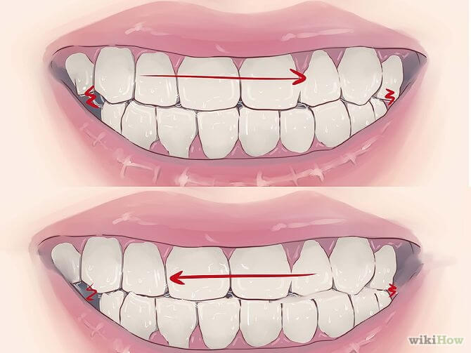 Cách khắc phục tật ngủ ngáy to kèm nghiến răng khi ngủ?