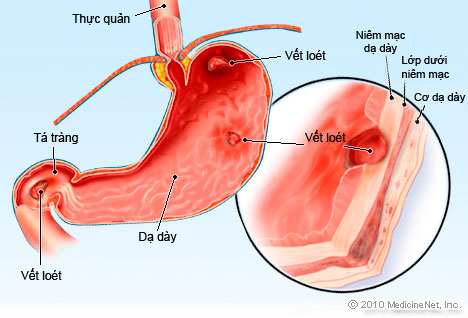 Kiến thức cần biết về bệnh đau dạ dày