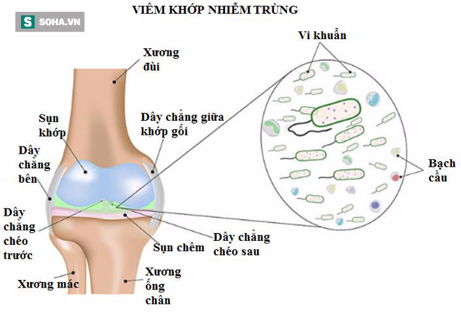 Đau nhức xương khớp đừng chủ quan: Đây có thể là nguyên nhân của 6 căn bệnh nguy hiểm