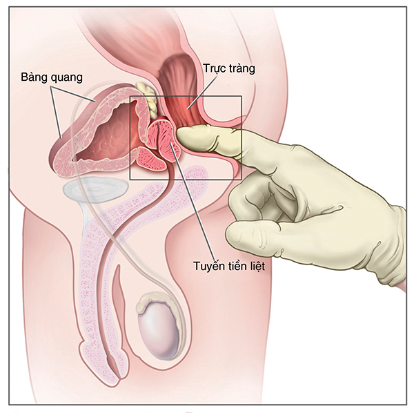 Những dấu hiệu u xơ tuyến tiền liệt
