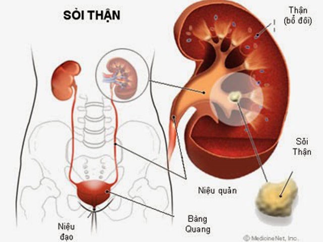 Bệnh sỏi thận có nguy hiểm không?