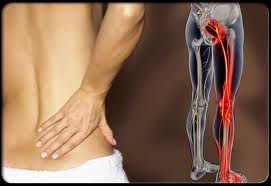Tiết lộ cách nhận biết đau dây thần kinh tọa