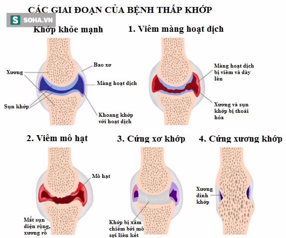 thấp khớp thấp khớp