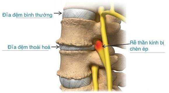 thoái hóa cột sống thoái hóa cột sống
