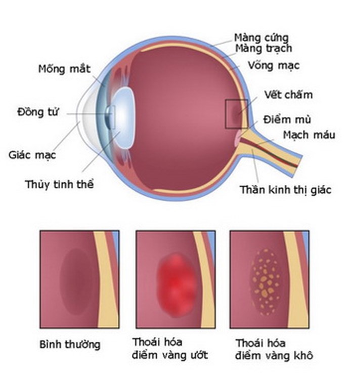 Những yếu tố tăng nguy cơ thoái hóa điểm vàng