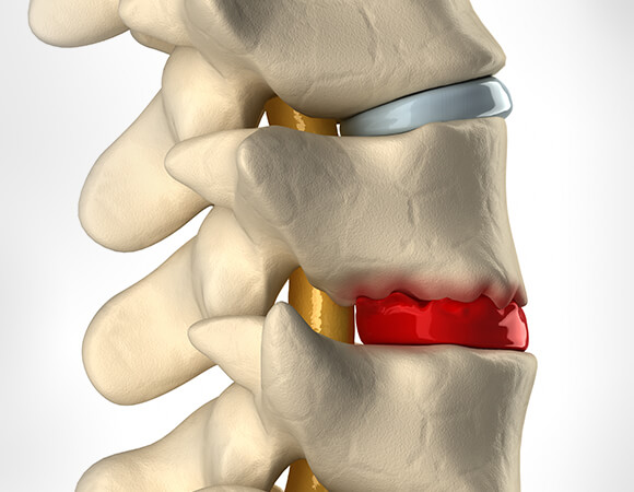 thoát vị đĩa đệm thoát vị đĩa đệm