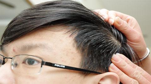 tóc bạc sớm tóc bạc sớm