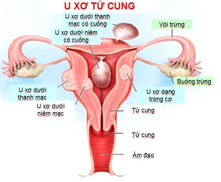 Vì sao phụ nữ hay bị u xơ tử cung, xử trí thế nào?