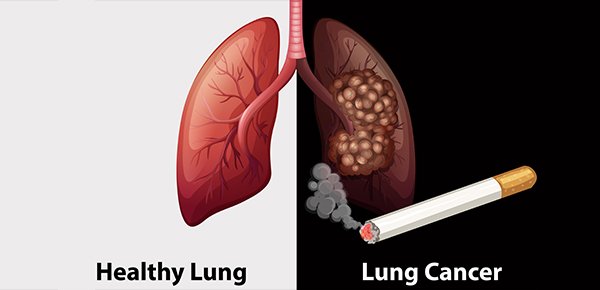 5 bệnh ung thư thường gặp đe dọa tính mạng đàn ông