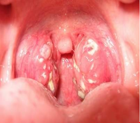 Sáu dấu hiệu nhận biết bạn có thể đã mắc phải bệnh ung thư vòm họng