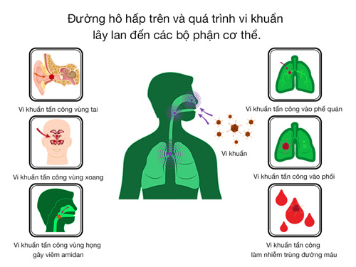 Các biến chứng nguy hiểm của viêm họng