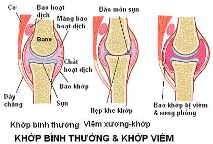 viêm khớp viêm khớp