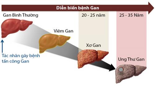 Xơ gan diễn tiến âm thầm nhưng nguy hiểm