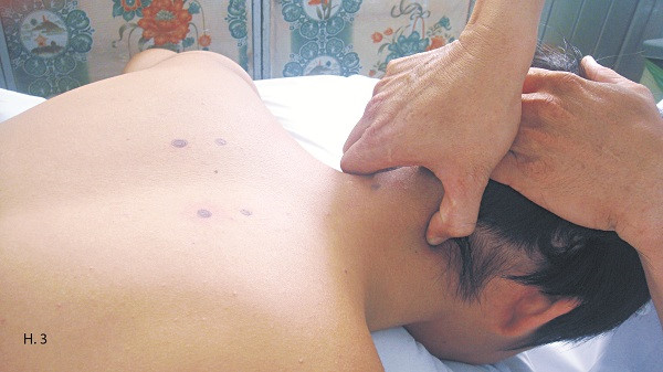 Xoa bóp chữa đau vai gáy do sai tư thế